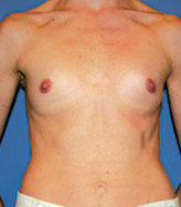 Patient # 75312 Before Photo # 1