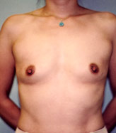 Patient # 44141 Before Photo # 1