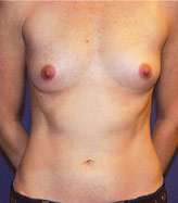 Patient # 44759 Before Photo # 1