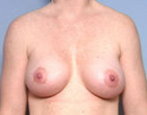 Patient # 22013 After Photo # 2