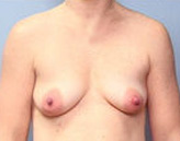Patient # 22013 Before Photo # 1