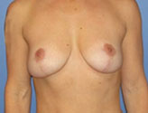 Patient # 55572 After Photo # 2