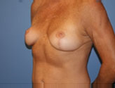 Patient # 10586 After Photo # 4