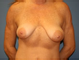 Patient # 10586 Before Photo # 1
