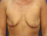 Patient # 78948 Before Photo # 1