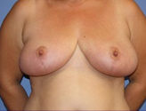 Patient # 46863 After Photo # 2