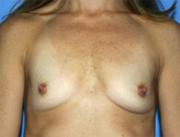 Patient # 23683 Before Photo # 1