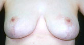 Patient # 84829 After Photo # 2
