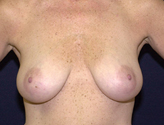 Patient # 57340 Before Photo # 1