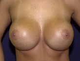 Patient # 76693 After Photo # 2