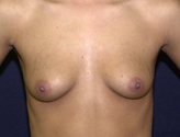 Patient # 76693 Before Photo # 1
