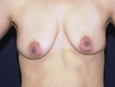 Patient # 90550 Before Photo # 1