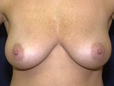 Patient # 56413 Before Photo # 1
