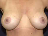 Patient # 20169 After Photo # 2