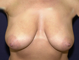 Patient # 76703 Before Photo # 1