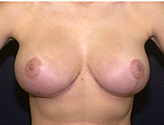 Patient # 88385 After Photo # 2