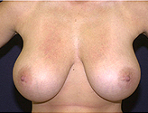 Patient # 88385 Before Photo # 1