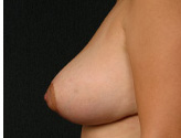Patient # 72984 After Photo # 6
