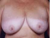 Patient # 32519 Before Photo # 1