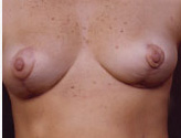Patient # 11947 After Photo # 2