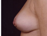 Patient # 11947 After Photo # 6