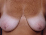 Patient # 11947 Before Photo # 1