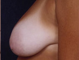 Patient # 11947 Before Photo # 5