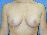 Patient # 11403 After Photo # 2