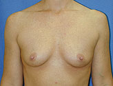 Patient # 11403 Before Photo # 1