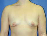 Patient # 66633 Before Photo # 1