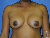 Patient # 27806 After Photo # 2