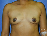 Patient # 27806 Before Photo # 1