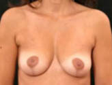 Patient # 36054 After Photo # 2