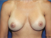 Patient # 47877 After Photo # 2