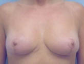 Patient # 64282 After Photo # 2