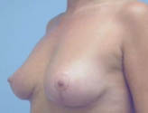 Patient # 64282 After Photo # 4
