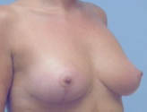 Patient # 64282 After Photo # 6