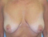 Patient # 64282 Before Photo # 1