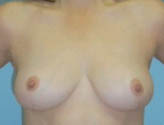 Patient # 42759 After Photo # 2