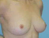 Patient # 42759 After Photo # 6