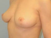 Patient # 65196 After Photo # 4