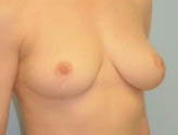 Patient # 65196 After Photo # 6