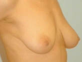 Patient # 65196 Before Photo # 5