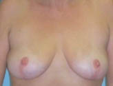 Patient # 36673 After Photo # 2