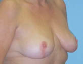 Patient # 36673 After Photo # 6