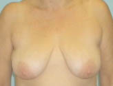 Patient # 36673 Before Photo # 1