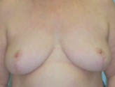 Patient # 78496 After Photo # 2