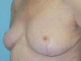 Patient # 78496 After Photo # 4