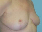 Patient # 78496 After Photo # 6