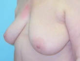 Patient # 78496 Before Photo # 3